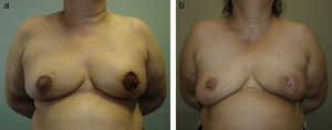 Despigmentación de la aréola tras isquemia superficial en una mamoplastia vertical bilateral.