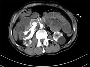 TC abdominal con contraste intravenoso: Aneurisma de aorta abdominal infrarrenal de 6×3,2cm con trayecto fistuloso filiforme aortoentérico (flecha) y paso de contraste a duodeno.