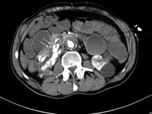 TC abdominal con contraste intravenoso: Presencia de contraste intravenoso en la luz intestinal (flechas).