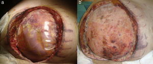A) Laparostomía descompresiva con bolsa de Bogotá tras síndrome compartimental abdominal. B) Epiploplastia y malla supraaponeurótica de polipropileno sustitutoria.