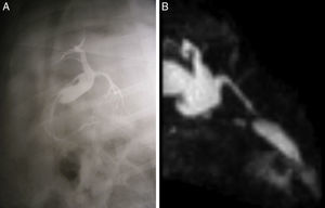 Se muestra dilatación de los hepáticos comunes y colédoco proximal, con permeabilidad del injerto, (se observa también la presencia de la vesícula biliar). A) Colangiografía intraoperatoria. B) Colangiorresonancia.