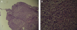 Los hallazgos microscópicos de las biopsias hepáticas a 60 días muestran ausencia de fibrosis, tejido hepático normal sin signos de colestasis, ni dilatación sinusoidal, (tinción con hematoxilina y eosina). A) Visión de bajo poder. B) Visión de alto poder.