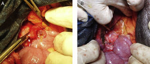 A) Extracción de tubo. B) Anastomosis hepaticoyetunal.