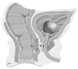 Abordaje transanal. Cierre del orificio uretral y flap de avance de pared total.