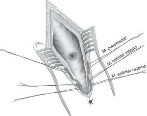 York-Mason: esquema de apertura parasacrocoxígea, transesfintérica.