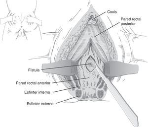 York-Mason: apertura en línea media.