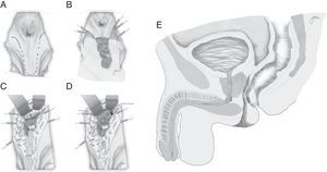 Abordaje perineal e interposición de dartos. A. Línea incisión piel. B. Elaboración flap dartos. C. Sutura uretral y rectal, en sentidos opuestos. D. Implantación dartos. E. Esquema final de implantación dartos.