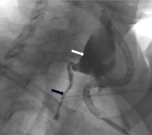Linfografía del conducto torácico (flecha negra) tras introducir contraste por el drenaje quirúrgico y rellenar el linfocele cervical (flecha blanca).