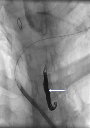 Embolización del conducto torácico con microcoils (flecha blanca) mediante acceso percutáneo transcervical.
