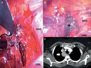 A) Se muestra el bocio parcialmente resecado. La resección se realiza mediante pinzas endoscópicas y LigaSure®. B) La estrella muestra el lecho quirúrgico. C) TC torácica (corte axial): se observa una masa paratraqueal de 3cm (marcada con una flecha blanca) en la región paramediastínica derecha. SVC: vena cava superior; URL: lóbulo superior derecho.