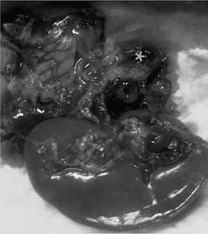 Pieza quirúrgica: esplenopancreatectomía distal con aneurisma de arteria esplénica roto (*).