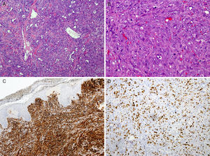 Estudio anatomopatológico de la pieza de mastectomía. A) Patrón epiteliode de la neoplasia (H&E x4). B) Se aprecian hematíes en el interior de algunas células, y un elevado número de mitosis por campo (H&E x10). C) Inmunohistoquímica. CD-31+, que pone de manifiesto su origen vascular. D) Ki-67. Alta tasa proliferativa, propia de la naturaleza de alto grado histológico.