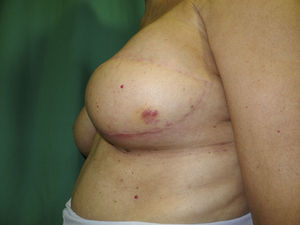 Recidiva en isla cutánea del colgajo de dorsal ancho.