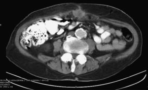 TAC abdominal con constraste iv y oral: lesión redondeada de centro hipodenso (necrótico) en línea media de pared abdominal, en situación periumbilical de aproximadamente 3,6cm.