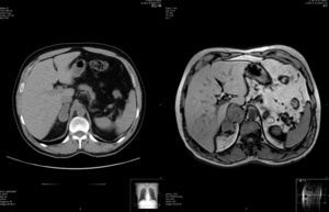 A la izquierda, la TC mostró una lesión nodular, inespecífica, en la glándula suprarrenal derecha, de 4×2,5×2cm. A la derecha, la resonancia magnética realizada 4 semanas más tarde muestra una masa suprarrenal derecha, heterogénea, de 6,8×4,4×3,9cm.