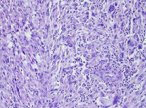 Mediante inmunohistoquímica, se mostró intensa positividad para Ki-67 (> 75%) y negatividad para queratina 8/18, queratinas AE1-AE3, la proteína S 100, HMB45, melan A, cromogranina y sinaptofisina, mostrando tinción intensa para vimentina, actina y desmina. Se muestra estudio anatomopatológico con aspecto citológico marcadamente atípico, altamente pleomórfico, con células de tamaño grande y marcadas irregularidades en tamaño nuclear con núcleos lobulados y nucléolos prominentes, con un índice mitótico de 10 mitosis por campo de gran aumento (H-E 200X).