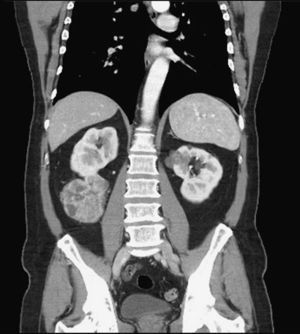 Tomografía computarizada abdominopélvica. Corte coronal donde se aprecia una masa sólida dependiente del polo renal inferior derecho de 8×7cm y otra lesión de 3cm en el polo renal superior izquierdo.