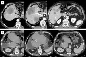 A) TAC inicial: múltiples metástasis de 1 a 10cm en segmentos derechos y segmento IV, una metástasis en segmento II y 2 en segmento III, superficiales de 0,5-1cm y segmento I libre de enfermedad. Nódulo pulmonar inespecífico de 0,5cm. B) TAC postoperatorio: ausencia de enfermedad hepática.