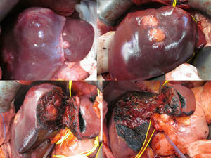 Imágenes del primer tiempo quirúrgico.