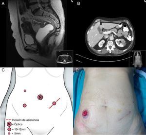 A) RM de pelvis donde se observa tumoración de recto que no sobrepasa la muscular propia. B) Imagen de TC axial de abdomen en la que se muestra masa renal izquierda de 5cm.C) Ubicación de los trocares utilizada para la realización de la nefrectomía y resección anterior baja. D) Imagen del abdomen de la paciente con la ileostomía de protección.