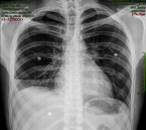 Radiografía de tórax posteroanterior: se aprecia un importante hidroneumotórax derecho con un colapso pulmonar moderado y un nivel hidroaéreo que llega a campo medio pulmonar derecho.