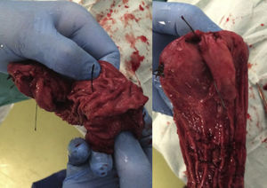 Se muestran los 2 pliegues tras la gastrectomía vertical. Uno en fundus gástrico y otro en antro. Durante la intervención ambas zonas se palpaban engrosadas.