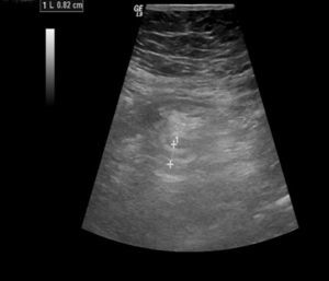 Ecografía abdominal compatible con proceso apendicular agudo con área flemonosa periférica.