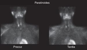 Gammagrafía paratiroidea en la que se objetivan 2 depósitos de actividad en polos inferiores, compatibles con adenomas paratiroideos.