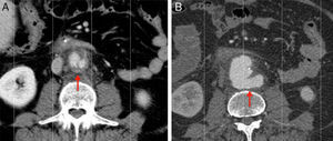 A) Corte transversal de TAC abdominal al ingreso, que muestra un aneurisma sacular de 3,5cm y aumento de densidad retroperitoneal y periaórtica. B) Corte transversal 5 días después donde se observa rápido crecimiento del aneurisma (diámetro mayor: 5,2) versus rotura contenida.