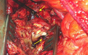 Imagen intraoperatoria: arriba se muestra ligadura del muñón aórtico y abajo se muestra, tras apertura del saco aneurismático, rotura en cara posterior del aneurisma que permite observar los ligamentos prevertebrales.