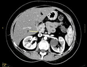 TAC abdominal que muestra: nódulo de 8mm (2) entre el duodeno-cabeza del páncreas (1) y la vena cava (3).