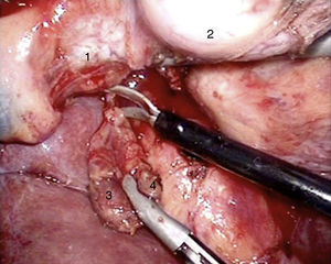 Imagen intraoperatoria a través de abordaje laparoscópico: colédoco (1), duodeno-cabeza del páncreas (2) y gastrinoma (3) rodeado de ganglios linfáticos libres de enfermedad (4).