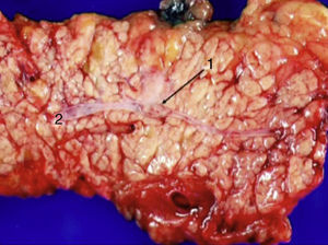 Gastrinoma en cuerpo pancreático (1) que ocluye parcialmente el conducto de Wirsung, produciendo dilatación distal (2).