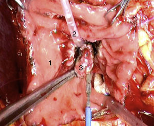 Duodenotomía longitudinal: pared duodenal posterior (1), cánula introducida en el orificio de la papila duodenal en el colédoco (2) y gastrinoma (3).