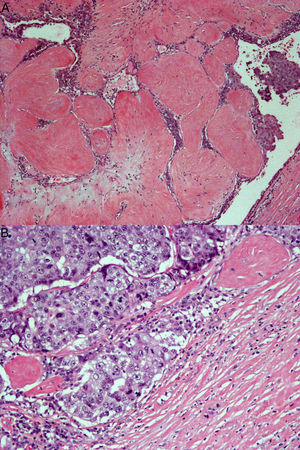 A) Se aprecia intensa atipia celular y frecuentes figuras de mitosis (H-E 20X). B) En la periferia de la lesión, se observa infiltración del estroma circundante, que confirma el diagnóstico de carcinoma ductal infiltrante (H-E 10X).