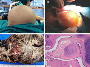 A) Distensión masiva abdominal. B) Material mucinoso de la cavidad (PMP). C) Imagen macroscópica del tumor mucosecretor ovárico. D) Tejidos maduros teratomatosos asociados al tumor mucinoso (Hematoxilina y Eosina, x4).