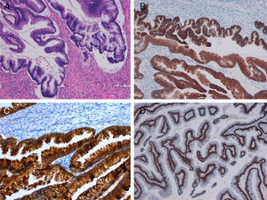 A) Imagen microscópica de tumor proliferativo mucinoso (Hematoxilina y Eosina, x10). B) Inmunoexpresión positiva citoplasmática difusa (Citoqueratina 7, x10). C) Positividad difusa citoplasmática (Citoqueratina 20, x20). D) Inmunotinción nuclear positiva difusa (CDX2, x10).