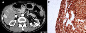 A) Páncreas residual y metástasis hepáticas. B) Tinción del tumor con melanina.