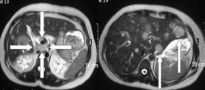 Resonancia magnética de abdomen superior donde las flechas indican un área de necrosis central del páncreas (derecha) y lesiones de metástasis en el hígado (izquierda).