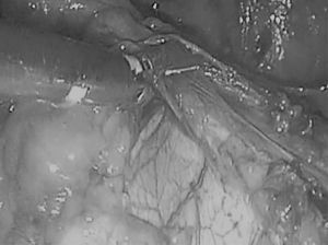 Resección de la grasa peritímica desde la cavidad cardiofrénica derecha.