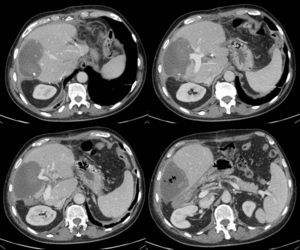 TAC postoperatorio en el que se observa necrosis del parénquima correspondiente al segmento IV y ausencia de contraste en ramas portales de dicho segmento.