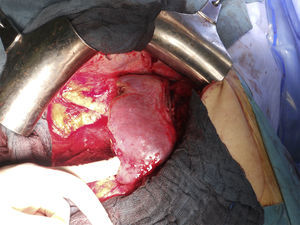 Remanente hepático tras las 2 intervenciones quirúrgicas.