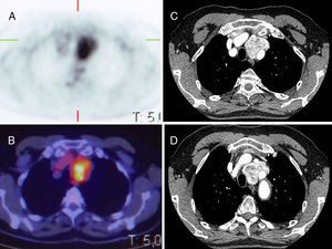 A. Captación del tumor en PET. B. Imágenes de fusión en PET/TC. C y D. Imágenes del tumor en angio-TC.