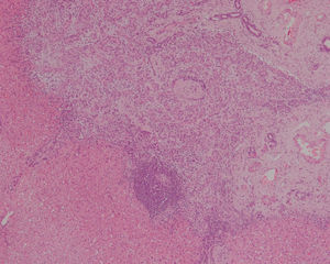 Proliferación nodular compacta de conductillos biliares, con infiltrado inflamatorio en su periferia (4x, hematoxilina-eosina).
