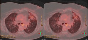 PET-TC mostrando infiltrado bilateral pulmonar.