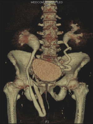 Reconstrucción 3D de una urografía computerizada multicorte (UROTAC) donde se evidencia una herniación ureteral derecha.