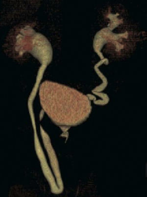 Reconstrucción tridimensional de una urografía multicorte donde se apecia mejor el trayecto de ambos uréteres y hallazgos de hidronefrosis derecha asociada a una hernia ureteral ipsilateral.