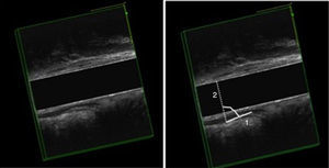 EEAD, corte sagital del canal anal medio y alto. Izquierda: reposo; Derecha: esfuerzo. Medida del ángulo anorrectal: Anismo. 1) línea en la porción interna del esfínter externo y puborrectal y 2) línea perpendicular al canal anal.
