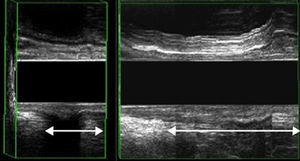 EEAD: Medida del descenso perineal. Izquierda: descenso normal (< 2cm); Derecha: descenso patológico.