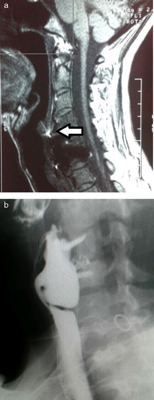 Imágenes del estudio preoperatorio: A) RMN cervical con sección sagital en la que se observa la placa de artrodesis en íntimo contacto con la pared posterior esofágica (flecha); B) Esofagograma con bario que muestra la impronta que deja la prótesis metálica con tornillos sobre una formación sacular esofágica cervical.